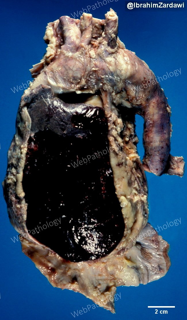 Aorta_aneurysm21A_dissecting_resized_IZ.jpg