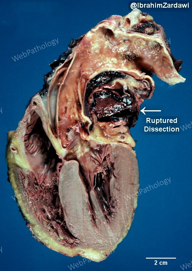 Aorta_aneurysm33_dissect_asc_resized_IZ.jpg