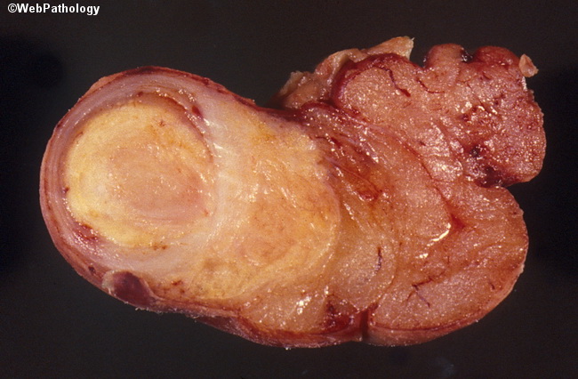Appendix_Carcinoid1_Cropped.jpg