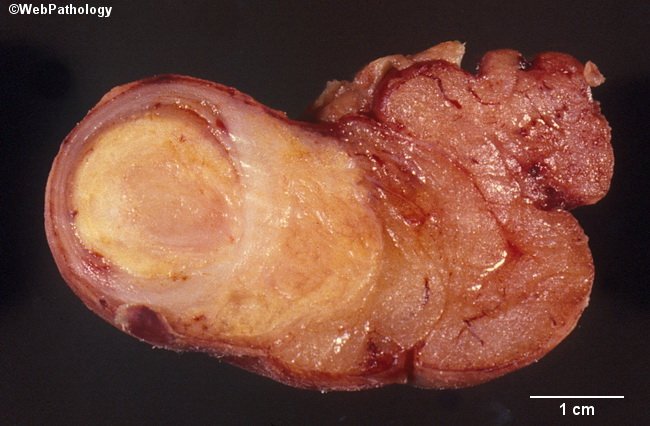 Appendix_Carcinoid1_Cropped2(1).jpg