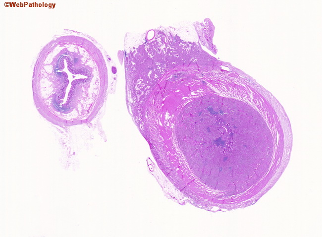 Appendix_Carcinoid2.jpg