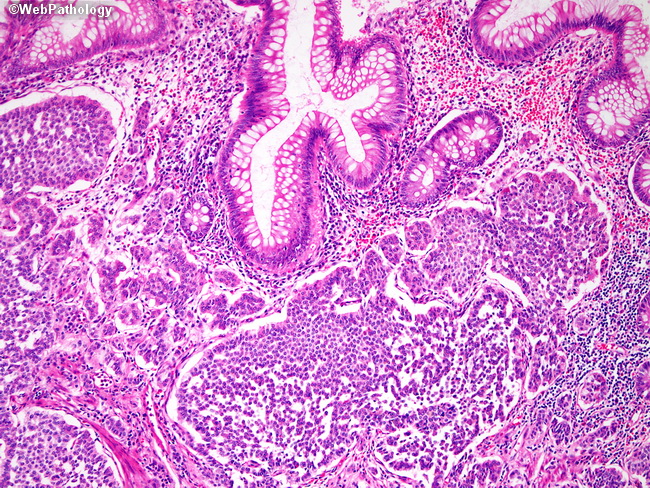 Appendix_Carcinoid22.jpg