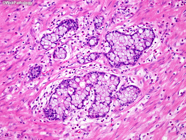 Clinicopathologic and molecular features of sporadic early-onset colorectal  adenocarcinoma: an adenocarcinoma with frequent signet ring cell  differentiation, rectal and sigmoid involvement, and adverse morphologic  features - Modern Pathology