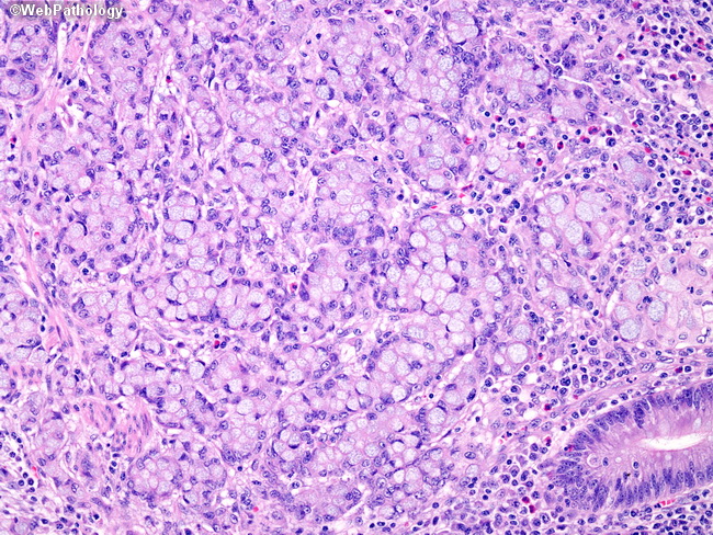 Signet-ring cell carcinoma of the appendix: Primary or  secondary tumor?