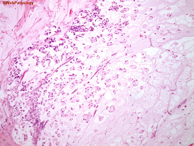 Appendix_MucinousCystadenoCA2.jpg