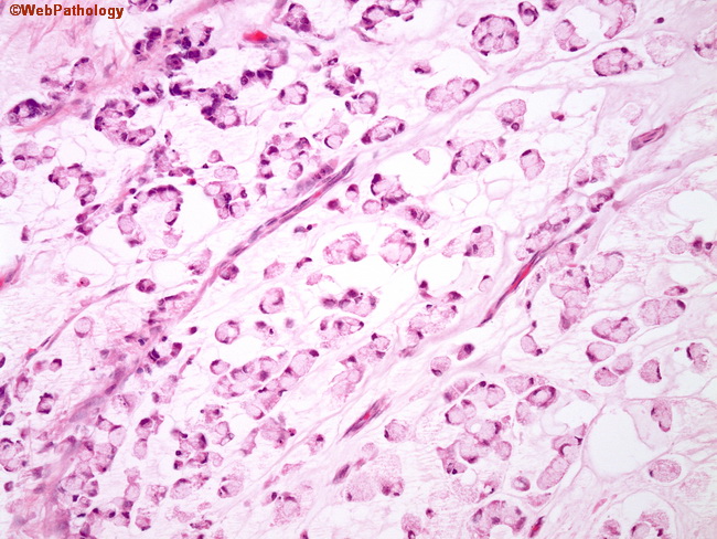 Appendix_MucinousCystadenoCA3.jpg