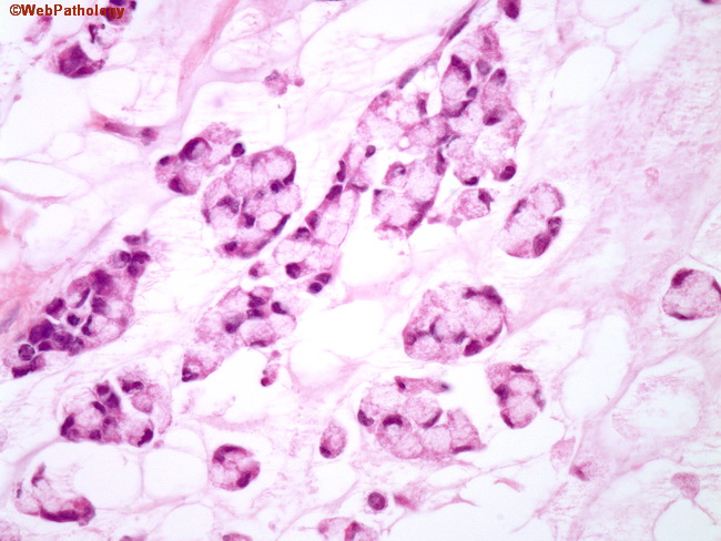 Appendix_MucinousCystadenoCA4.jpg