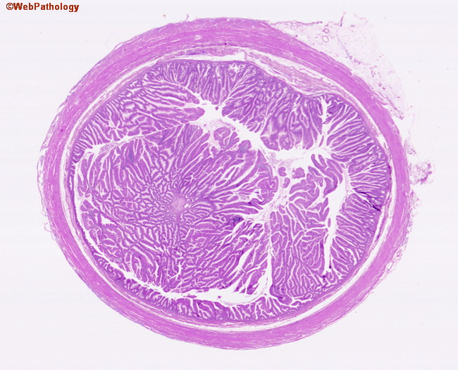 Appendix_MucinousCystadenoma1.jpg
