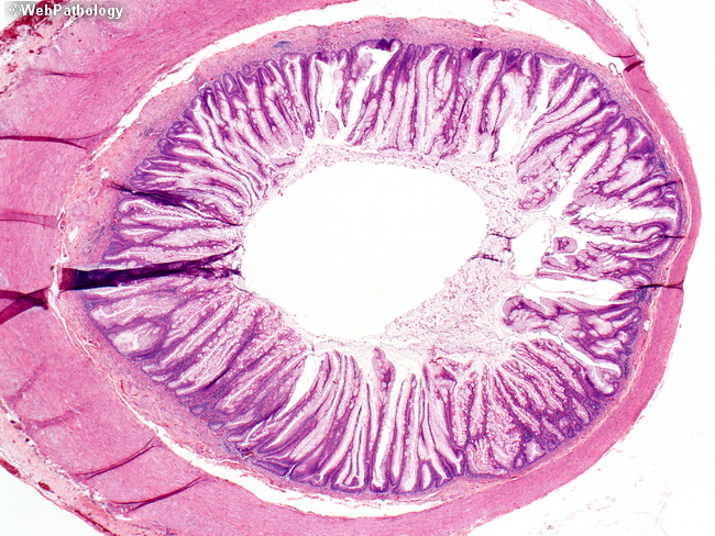 Appendix_MucinousCystadenoma10.jpg