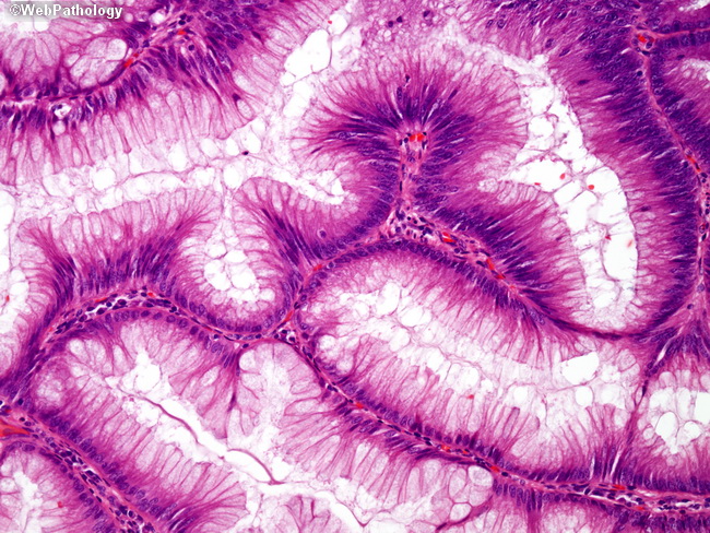 Appendix_MucinousCystadenoma12.jpg