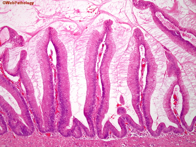 Appendix_MucinousCystadenoma14.jpg