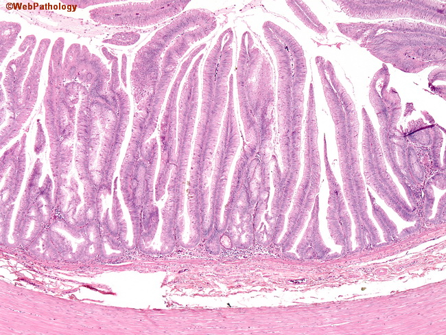 Appendix_MucinousCystadenoma2.jpg