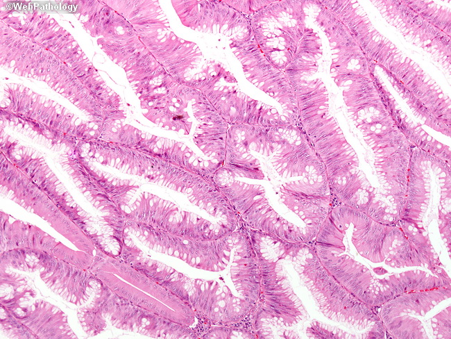 Appendix_MucinousCystadenoma6.jpg