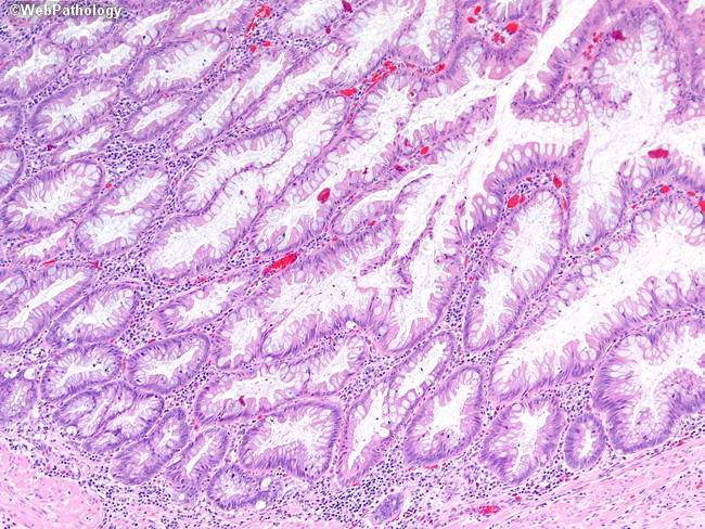 Appendix_MucinousCystadenoma7.jpg