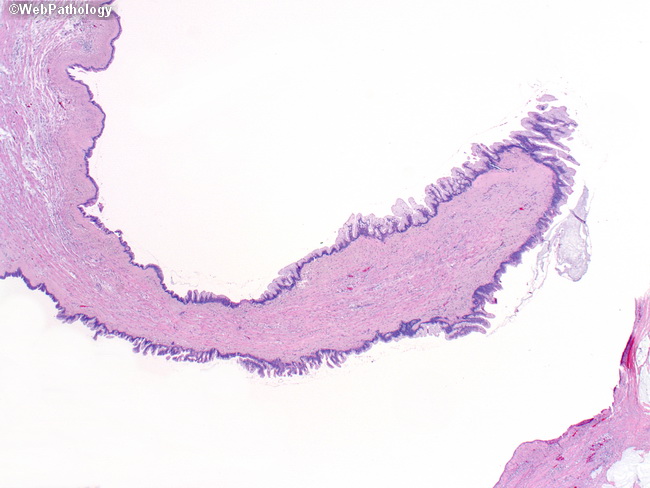 Appendix_PseudomyxomaPeritonei2.jpg