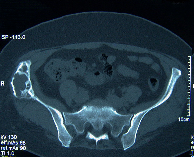 Bone_ChondromyxoidFibroma2_MRI.jpg