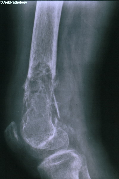Bone_Fibrosarcoma1.jpg