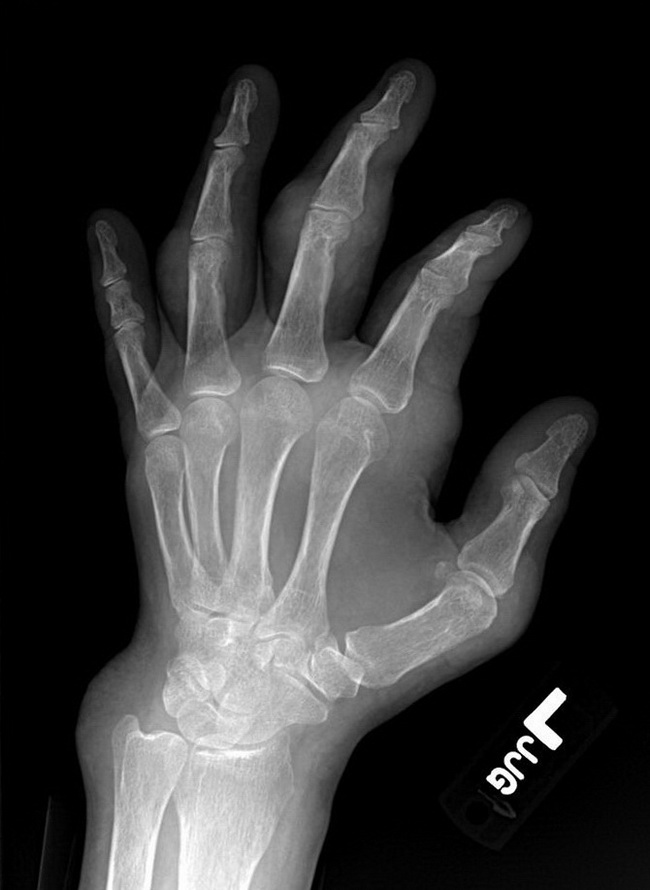 Bone_Gout_Oblique_Radiology1_resized.jpg