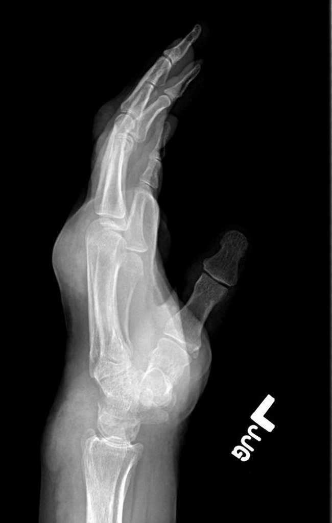 Bone_Gout_Radiology2_lateral_resized.jpg