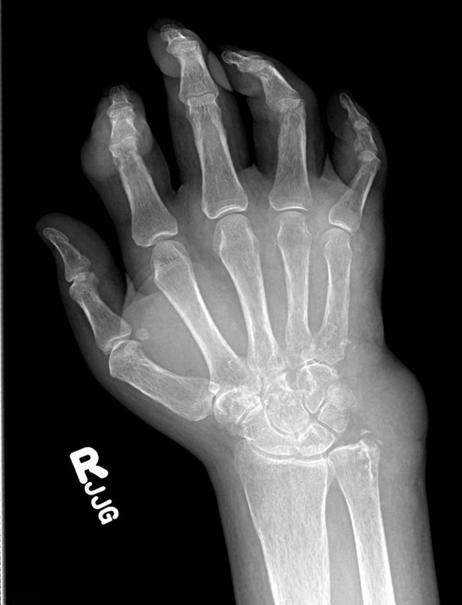 Bone_Gout_Radiology3_PA_resized.jpg