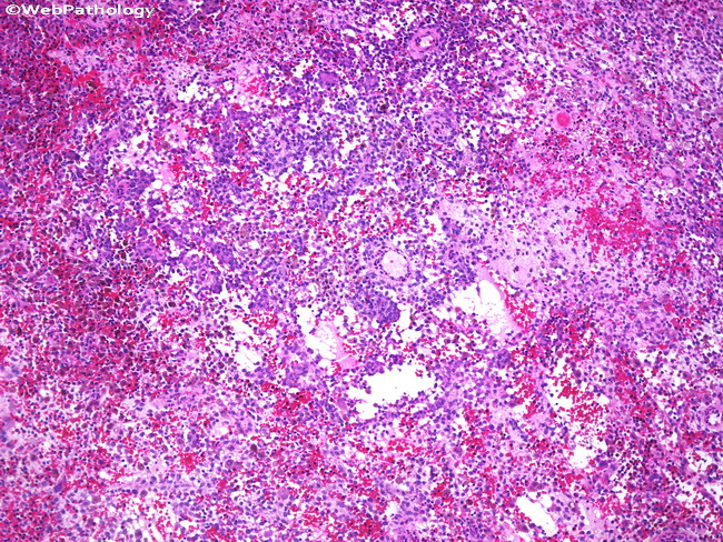 Bone_LangerhansCellHistiocytosis1.jpg