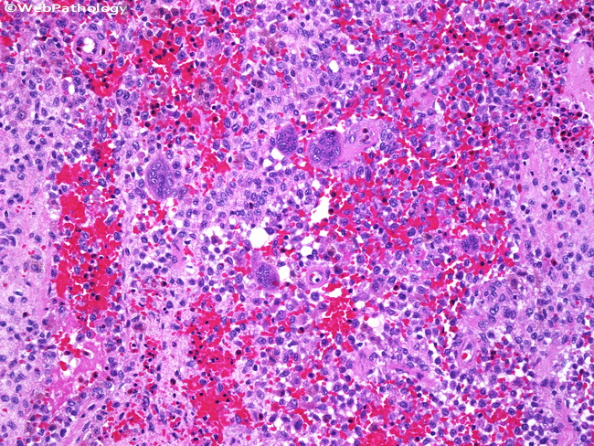 Bone_LangerhansCellHistiocytosis2.jpg
