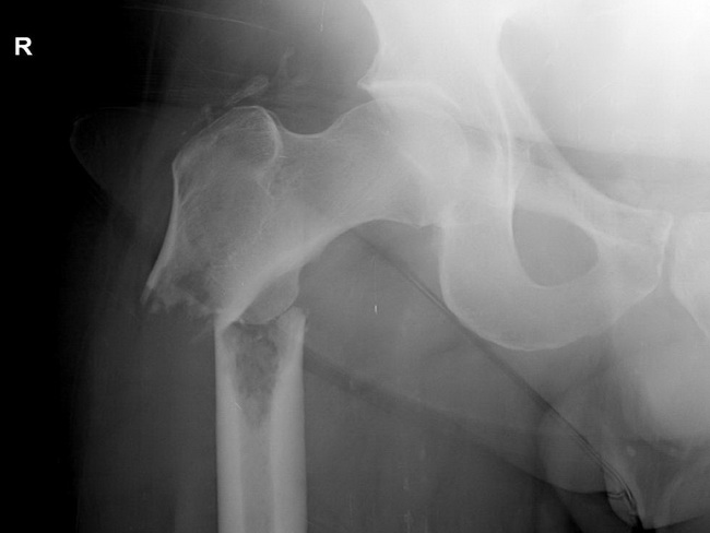 Bone_MM_Radiology9_resized.jpg