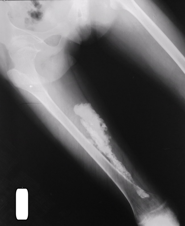 Bone_MyositisOssificans_Radiology1.jpg