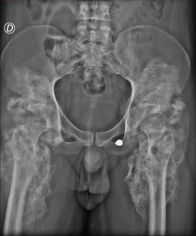 Bone_MyositisOssificans_Radiology2.jpg