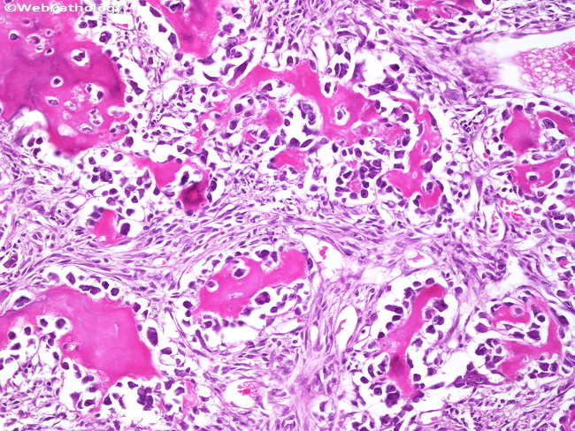 Bone_Osteoblastoma2.jpg
