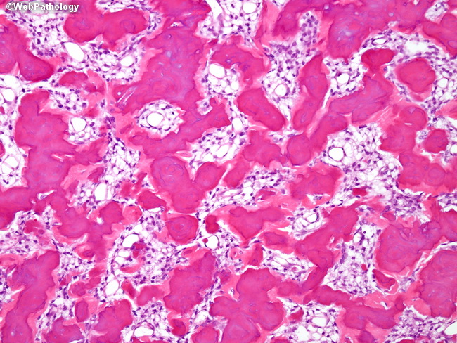 Bone_Osteoblastoma8.jpg