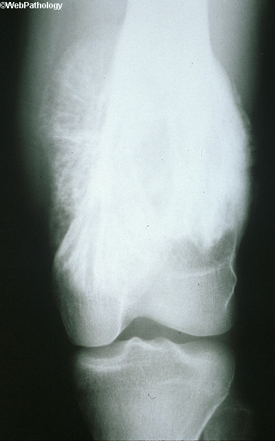 Bone_Osteosarcoma1.jpg
