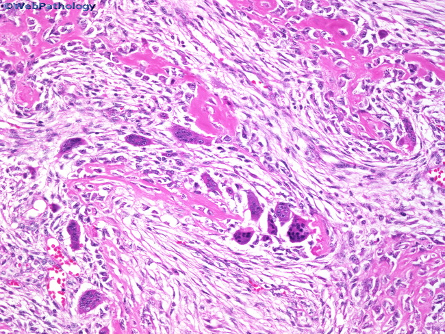Bone_Osteosarcoma16_GiantCells.jpg