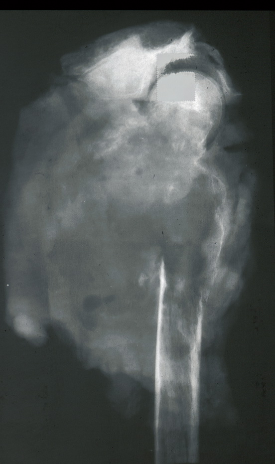Bone_Osteosarcoma3_Xray.jpg