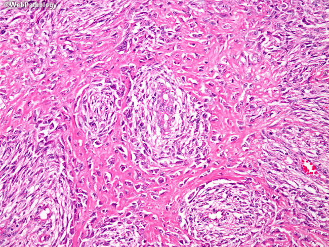 Bone_Osteosarcoma59_Fibroblastic.jpg