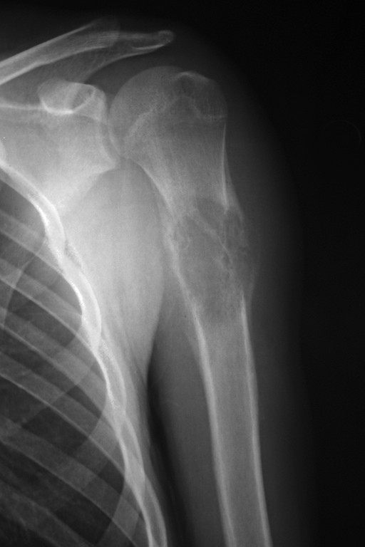 Bone_Osteosarcoma6_Xray.jpg