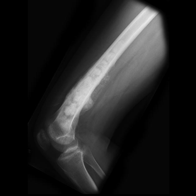 Bone_Osteosarcoma_Radiology_1B.jpg