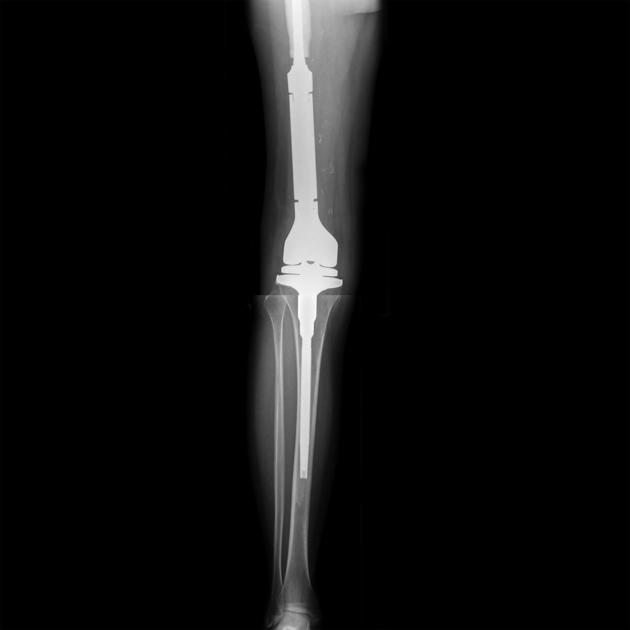 Bone_Osteosarcoma_Radiology_1D.jpg