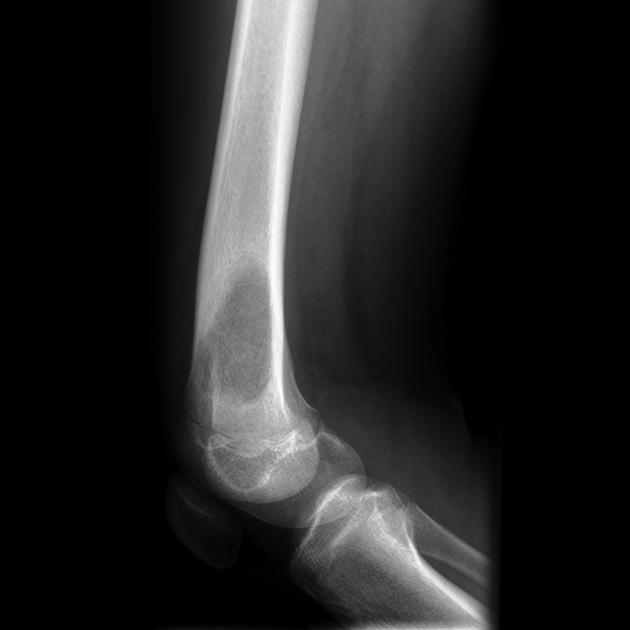 Bone_Osteosarcoma_Radiology_2B.jpg