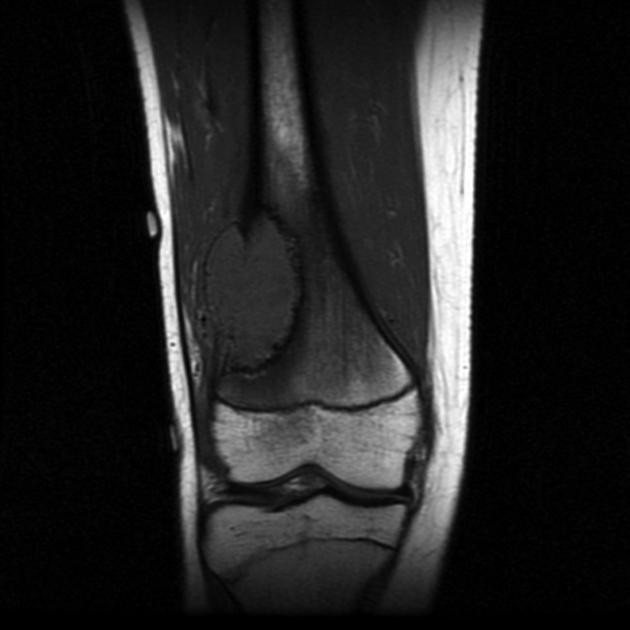 Bone_Osteosarcoma_Radiology_2C.jpg