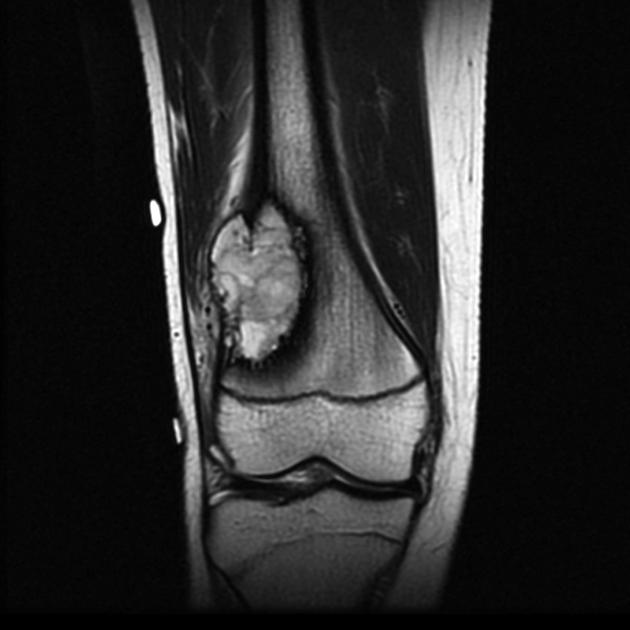 Bone_Osteosarcoma_Radiology_2D.jpg