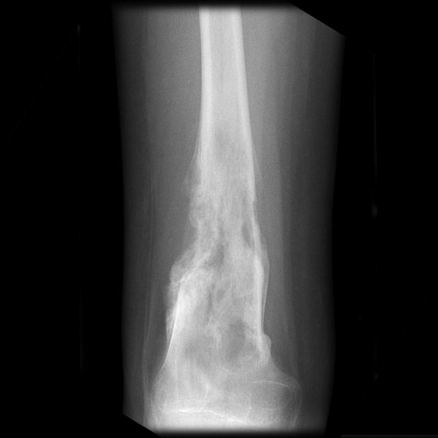 Bone_Osteosarcoma_Radiology_3B.jpg
