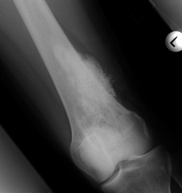 Bone_Osteosarcoma_Radiology_Parosteal.jpg