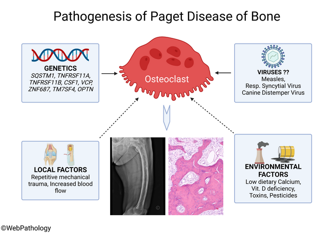 Bone_PagetDz_Illustration_Pathogenesis_resized(1).png