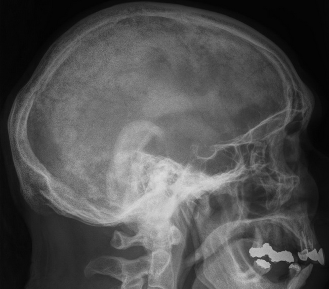 Bone_PagetDz_Radiology1_resized.jpg