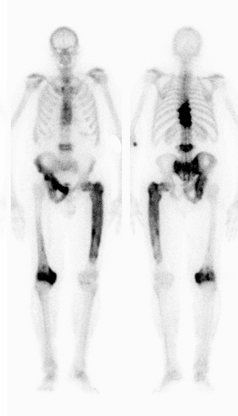 Bone_PagetDz_Radiology4_cropped.jpg