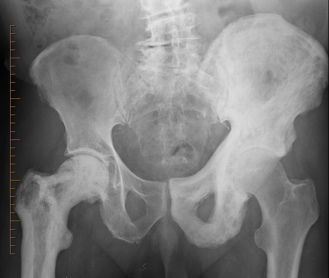 Bone_PagetDz_Radiology6_resized.jpg