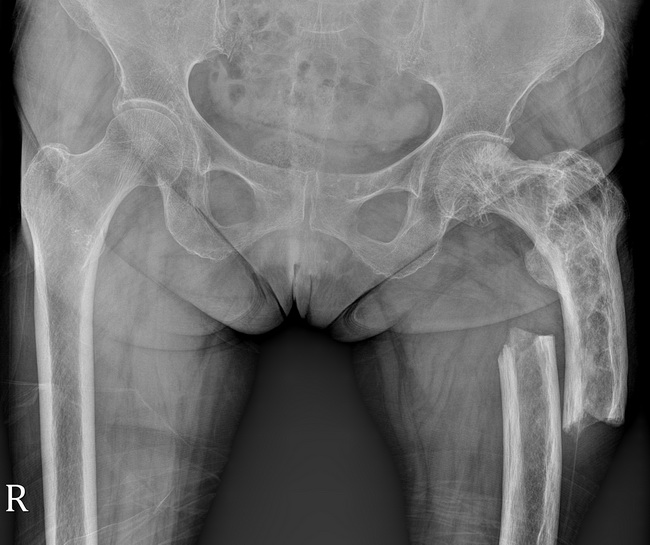 Bone_PagetDz_Radiology7C_resized.jpg