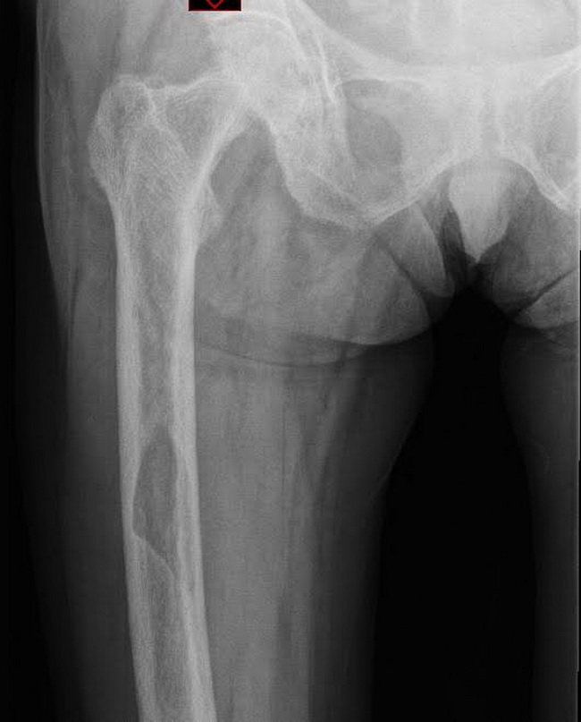 Bone_PagetDz_Radiology8_resized.jpg