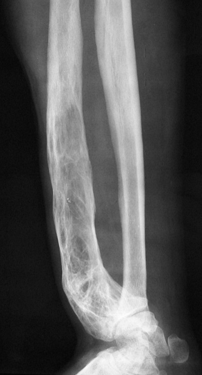 Bone_PagetDz_Radiology9.jpg